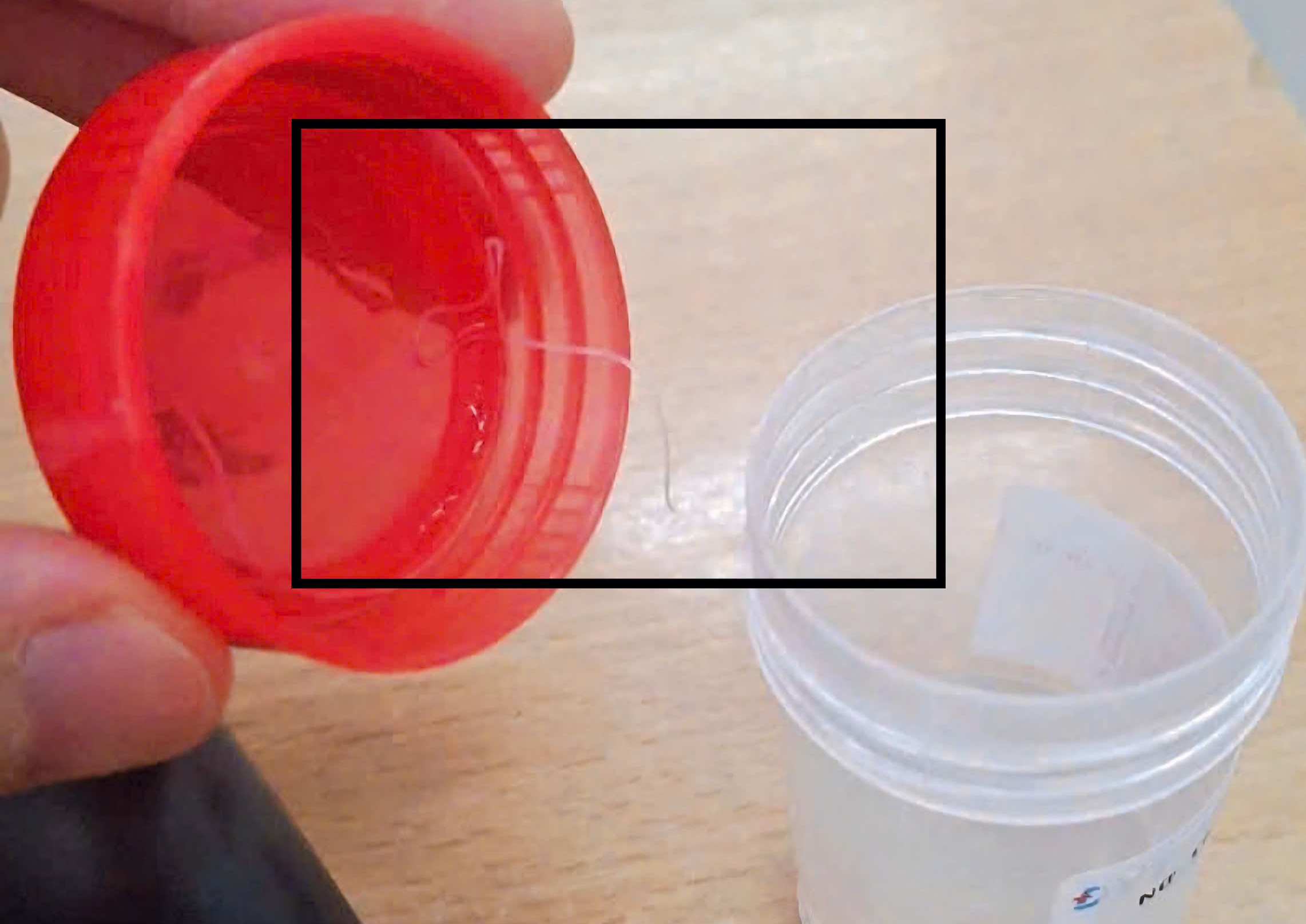 The nearly 10cm parasitic parasite is removed from the eyes of the sick. Photo: Thanh Dang