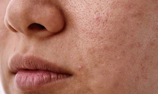 Nếu làn da của bạn trở nên đỏ, viêm hoặc nhạy cảm, hãy áp dụng ngay các biện pháp sau để làm dịu làn da. Ảnh: Hương Sơn
