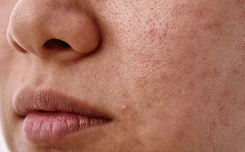 If your skin becomes red, inflamed or sensitive, take the following measures immediately to soothe the skin. Photo: Huong Son