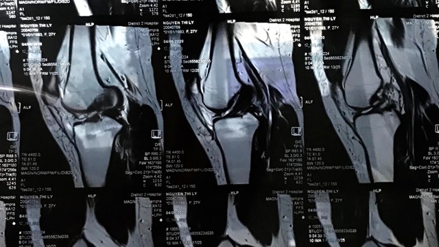 La tomografia del paciente con la ligadura anterior transversal rota. Imagen de la pagina web de la organizacion