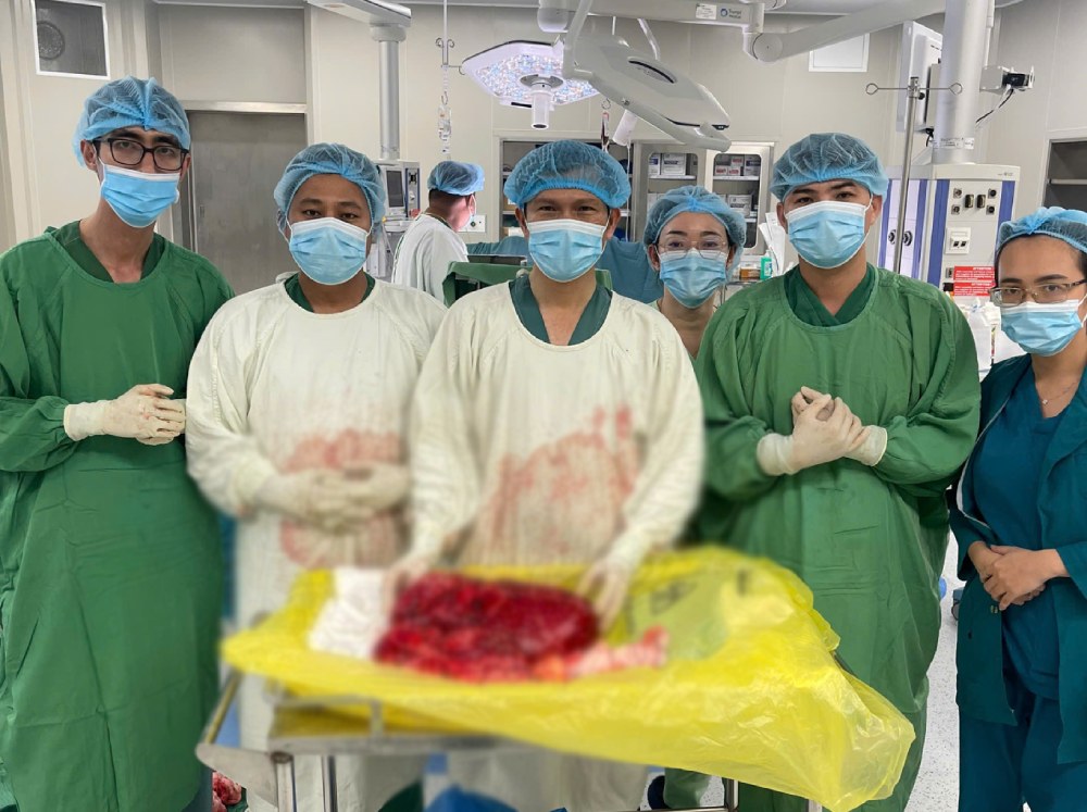 The tumor weighing about 8kg was removed from the body of a 60-year-old male patient. Photo: Kien Giang Oncology Hospital