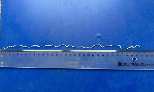 Ghi nhận ca bệnh giun rồng ở Việt Nam. Ảnh: BSCC
