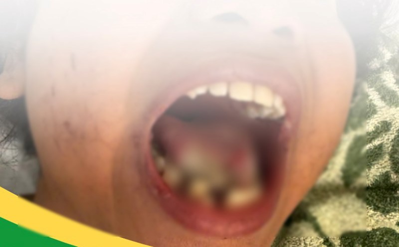 When admitted to the hospital, the child continuously screamed and destroyed himself, such as biting his lips, biting his tongue, causing bleeding, soft tissue damage, and broken teeth. Photo: Provided by the hospital