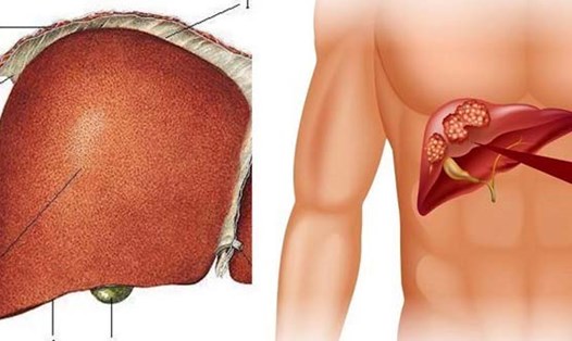 Có thể giảm gan nhiễm mỡ bằng món ăn được nhiều độ tuổi ưa thích