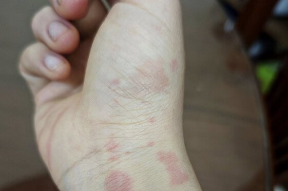 La causa de la irritacion de la piel. Imagen de la pagina web de la Universidad de Hong Kong