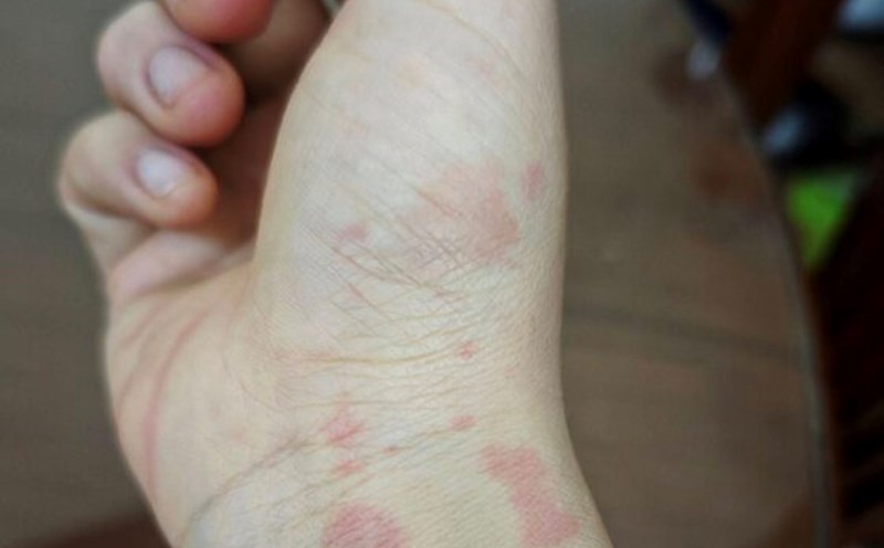 Causes of redness. Photo: Thuy Duong