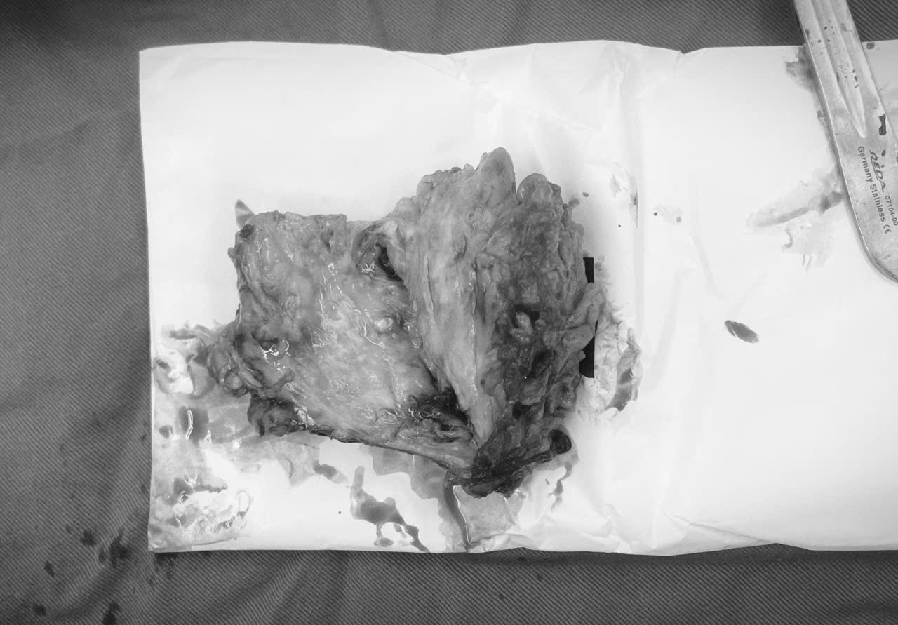 El tumor y el utero fueron extirpados completamente, identificados como un cancer poco comun. Imagen de la ciudad de Qingdao