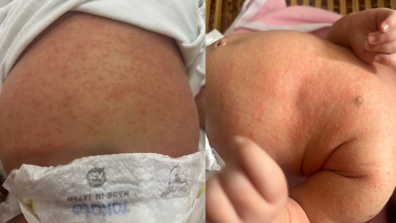 El hospital esta rojo por el calor. Imagen de la pagina web de la organizacion