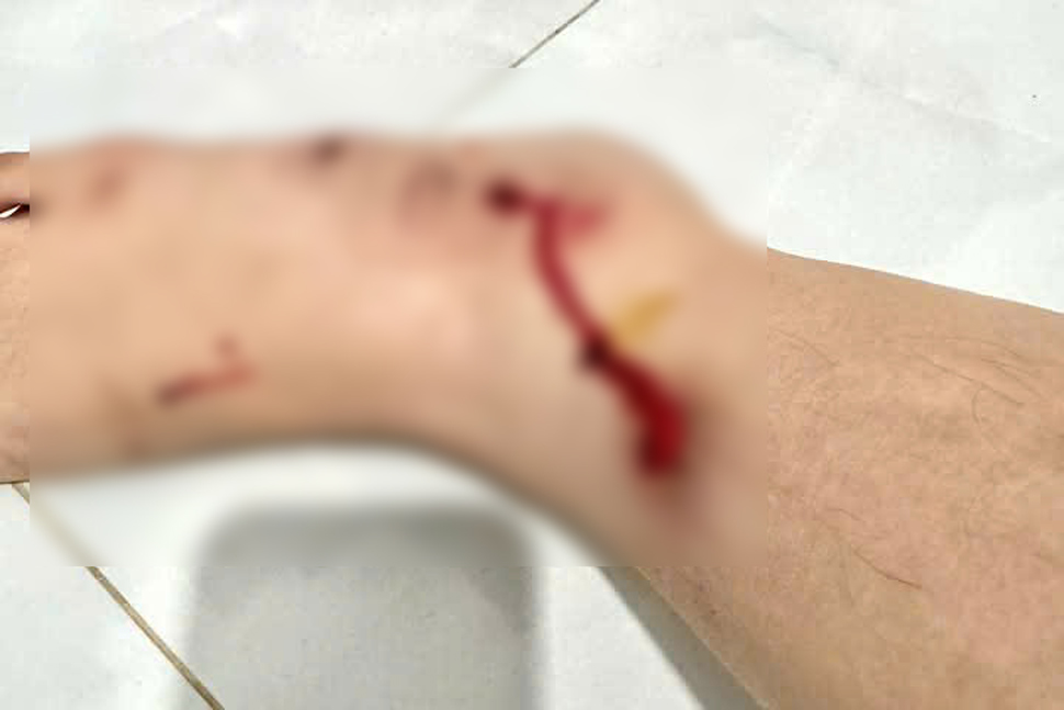 The girl was injured after fighting with a phone robber on Nha Trang street at night. Photo: Phuong Linh