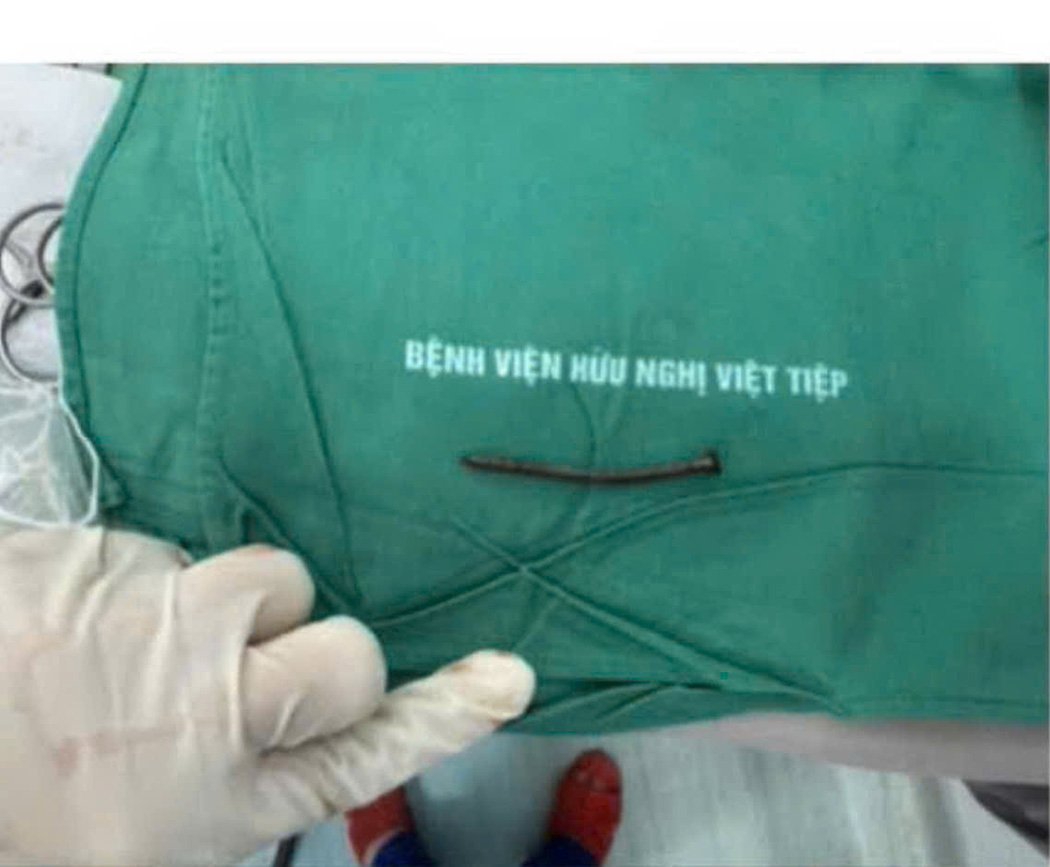 The 6cm long nail in the man's head was successfully operated on by doctors at Viet Tiep Hospital (Hai Phong). Photo: Provided by the hospital