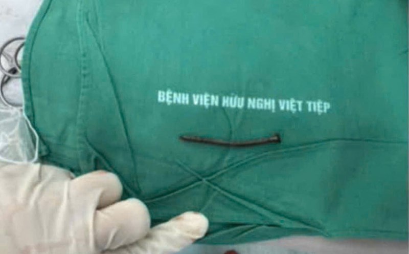 The 6cm long nail in the man's head was successfully operated on by doctors at Viet Tiep Hospital (Hai Phong). Photo: Provided by the hospital