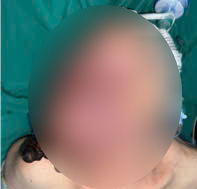 La señora Doen fue operada de un tumor sanguineo enorme en la cara. Foto: Hospital de la Amistad Vietnam-Cuba