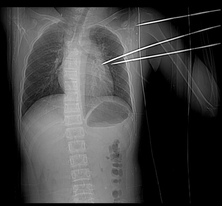 La imagen de un monstruo metalico castrado atraveso el corazon del enfermo. Imagen de la BVCC