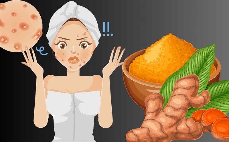How to use turmeric to effectively treat acne. Graphic photo: Hoang Loc