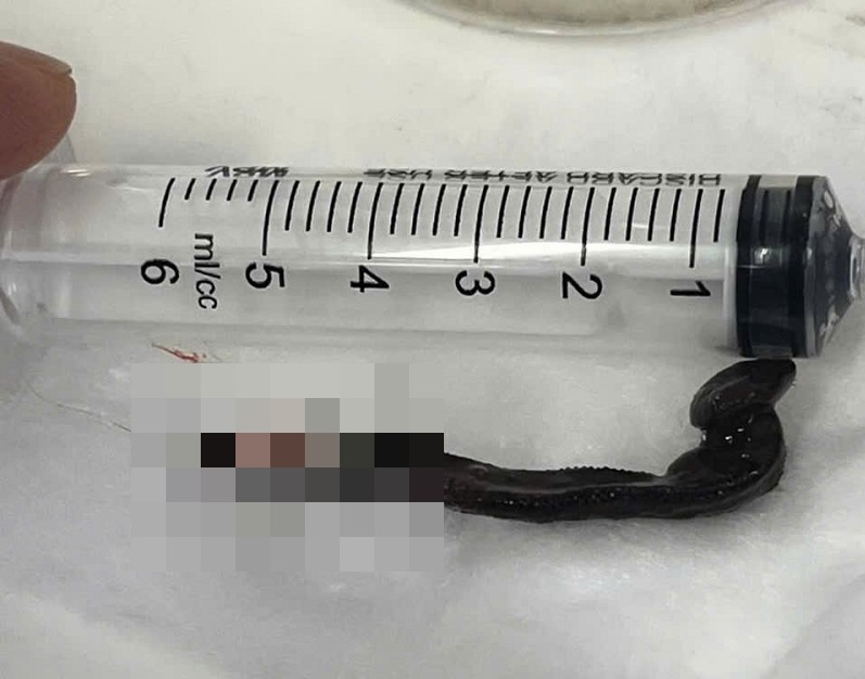 Los medicos han logrado extraer el tornillo de la nariz de la paciente. Imagen de la pagina web de la Universidad de Hong Kong