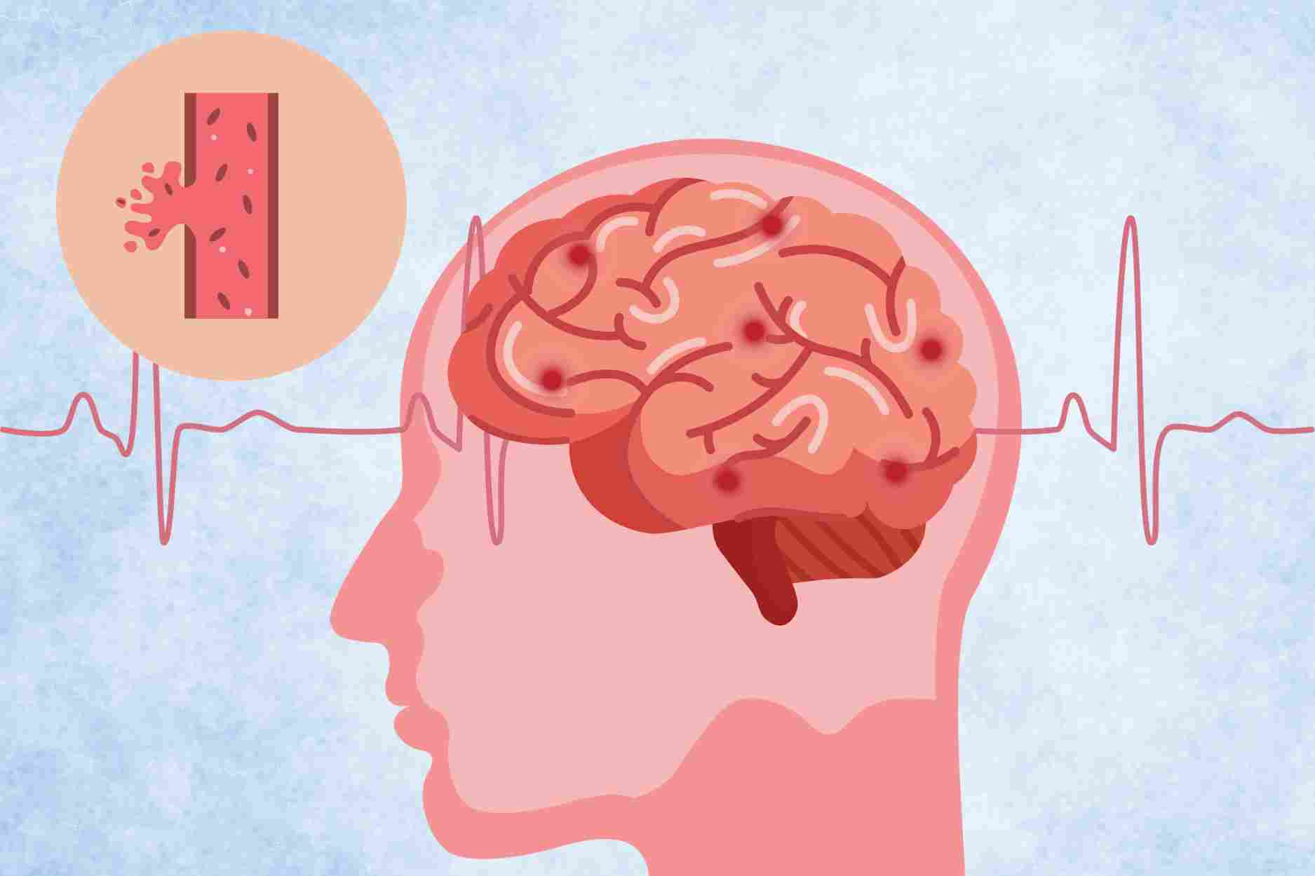 The mechanism of effect of staying up late causes the risk of stroke and high blood pressure