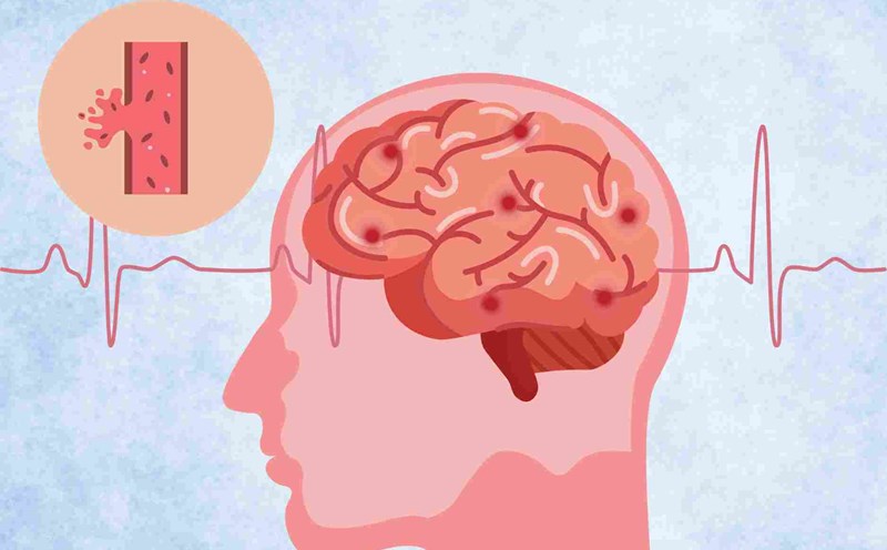 The mechanism of effect of staying up late causes the risk of stroke and high blood pressure