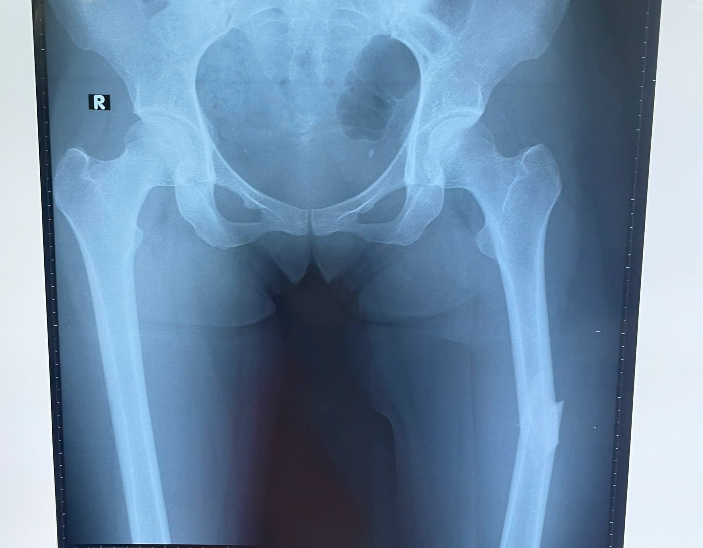 The female patient broke her thigh while playing pickleball. Photo: Provided by the hospital