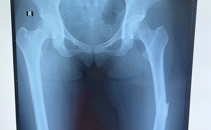 The female patient broke her thigh while playing pickleball. Photo: Provided by the hospital