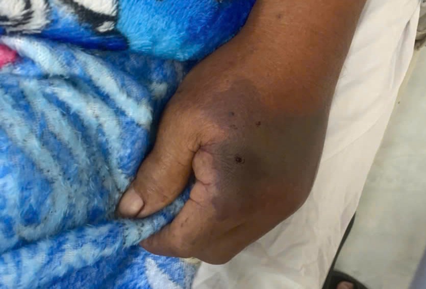 The health of the victim bitten by a poison snake has gradually recovered. Photo: Nhat Ho