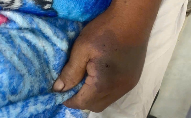 The health of the victim bitten by a poison snake has gradually recovered. Photo: Nhat Ho