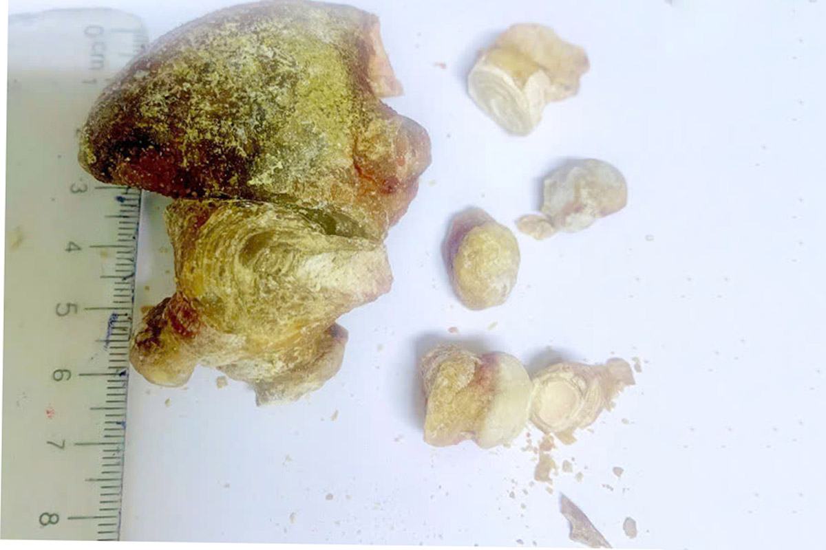 El coral de 7 cm de tamaño fue extraido de un riñon de un hombre de 70 años durante una cirugia realizada por medicos del Hospital Vietnam-Sueco Uong Vi, provincia de Quang Ninh. Foto: BV Vietnam - Suecia El Hombre de las Obras