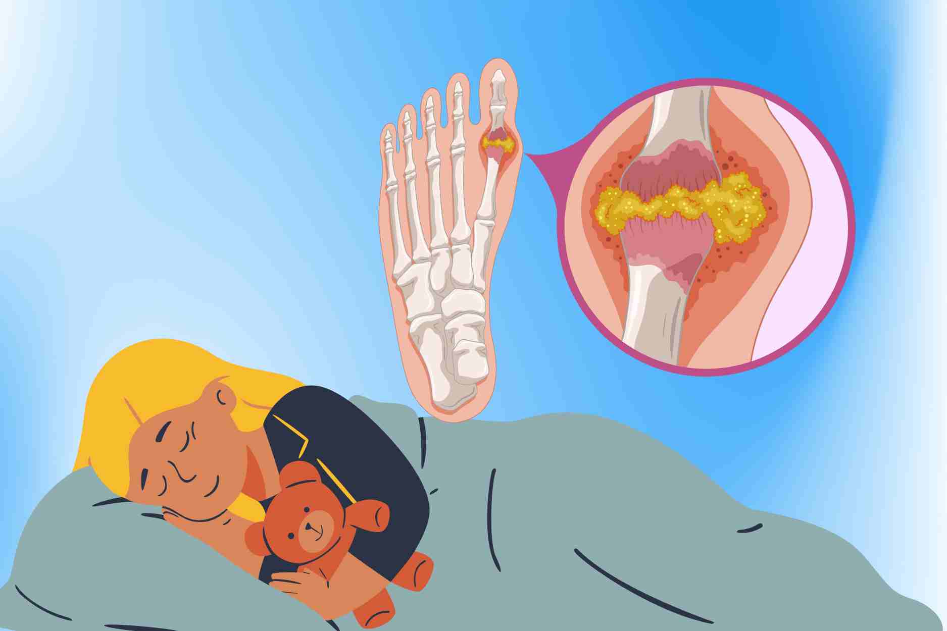 La regla de oro ayuda a dormir bien a las personas con niveles altos de acido urico. El dibujo: