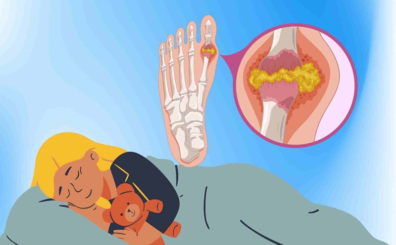 The golden principle helps people with high uric acid sleep well. Graphics: Dinh Dinh