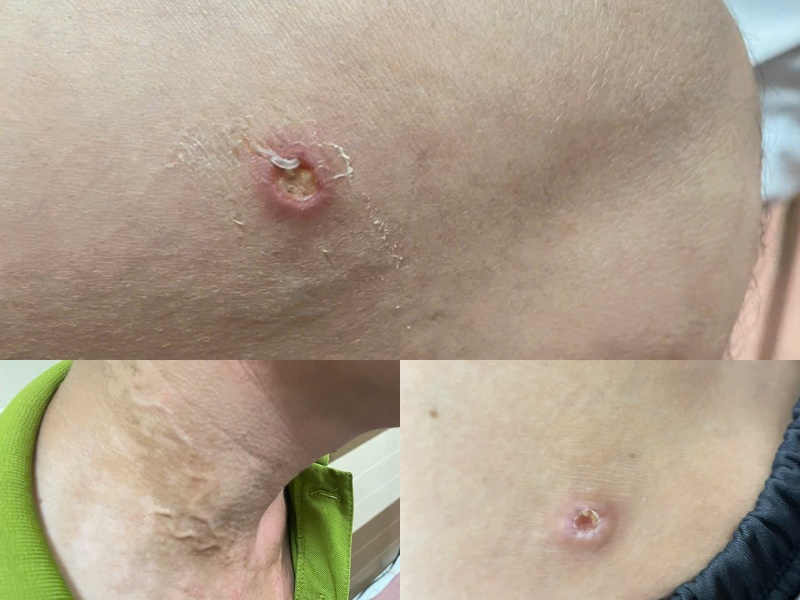 Las lesiones en la piel de los pacientes infectados por el dragon. Foto: Centro Medico del Distrito de Yiling