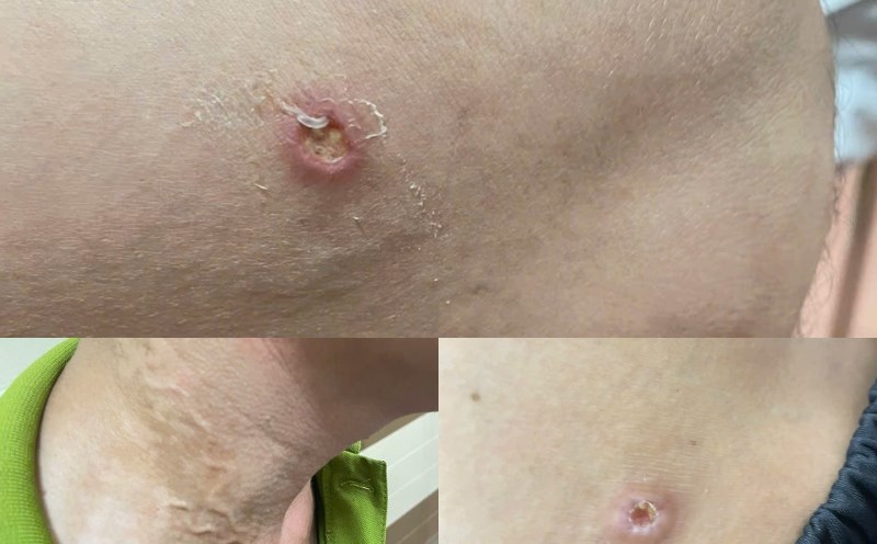 The skin damage of the patient was caused by dragon worm. Photo: Yen Lap District Medical Center