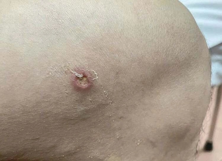 Benh nhan mac giun rong. Anh: BVCC