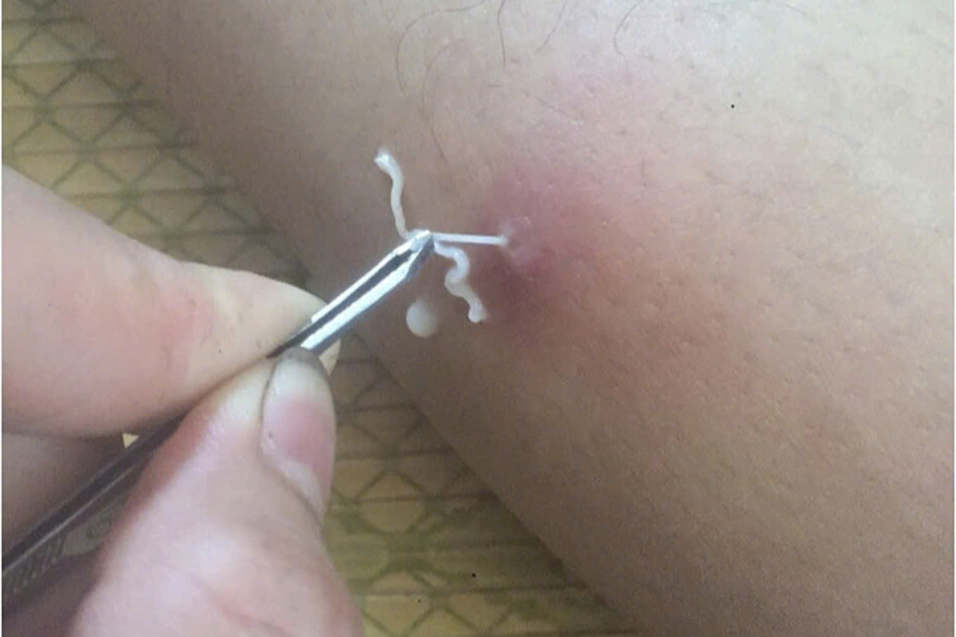 The dragon worm crawled out of the patient's body. Photo: CDC Hoa Binh