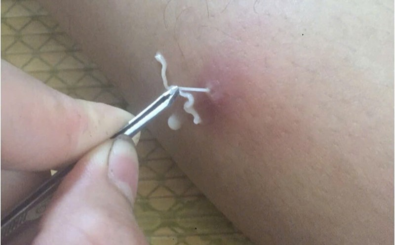 The dragon worm crawled out of the patient's body. Photo: CDC Hoa Binh