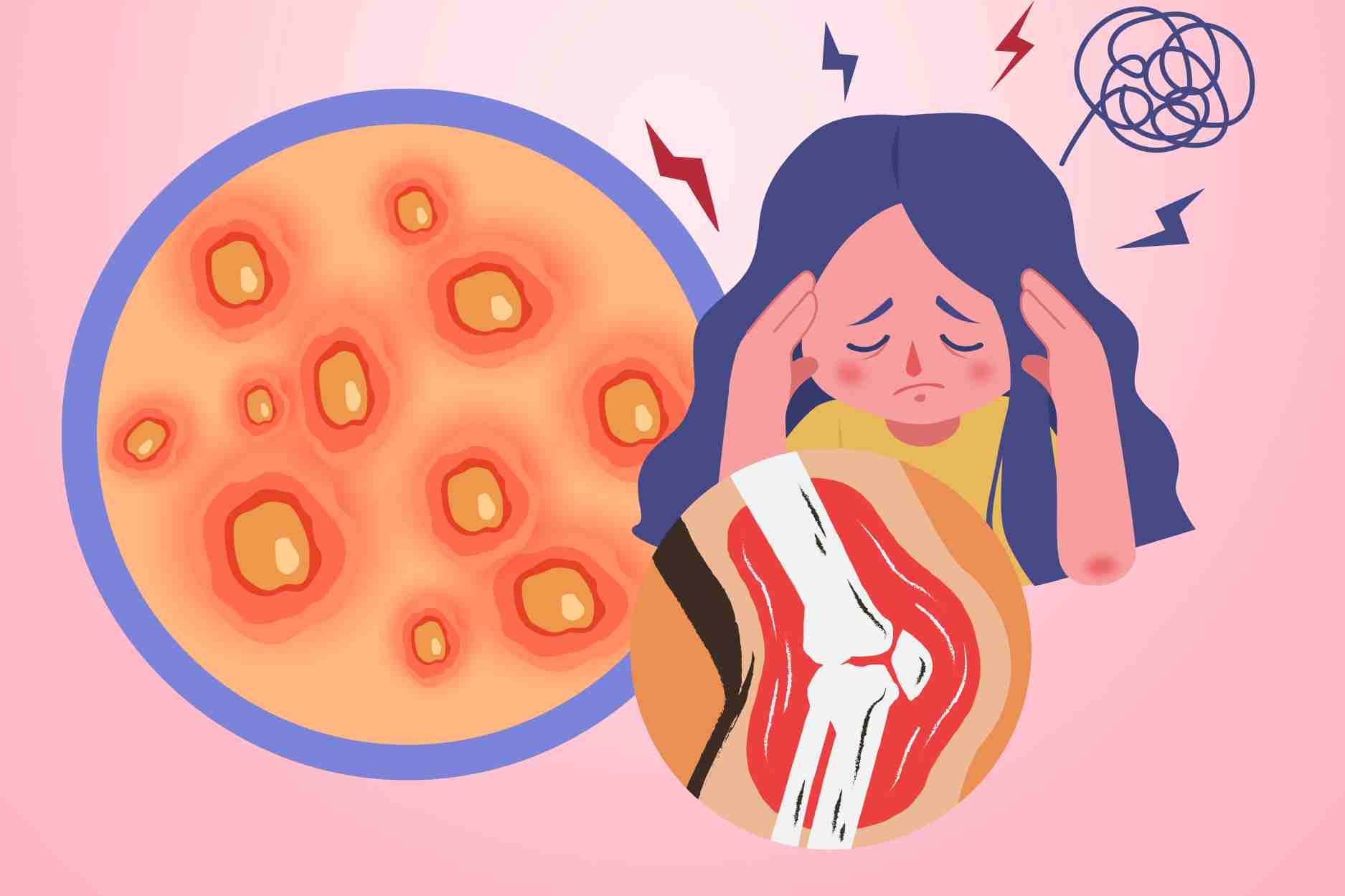 La complicacion de los gusanos dragones provoca incapacidad laboral y riesgo de depresion