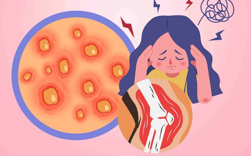 Dragon worm complications cause unable to work and risk of depression