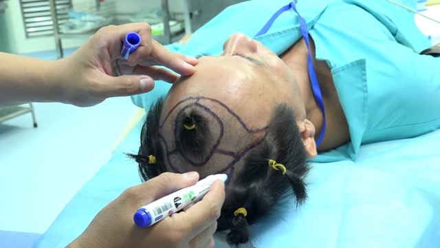 Muchas personas optan por implantes capilares para corregir la calvicie, la perdida de cabello. Imagen de la pagina web de la organizacion