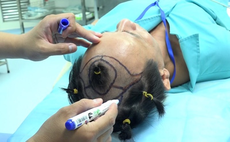 Many people choose hair transplantation to fix fried hair and hair loss. Photo: NGUYEN LY