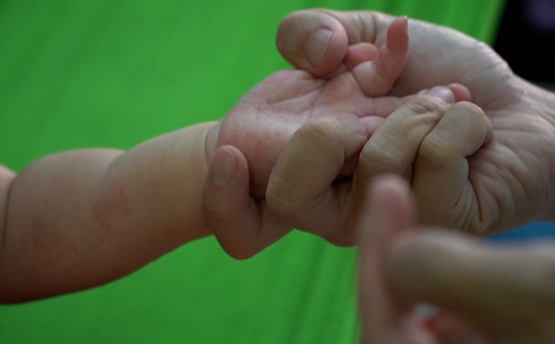 The child suffered from hand, foot and mouth disease with red spots on his hand. Photo: CHAN PHAC