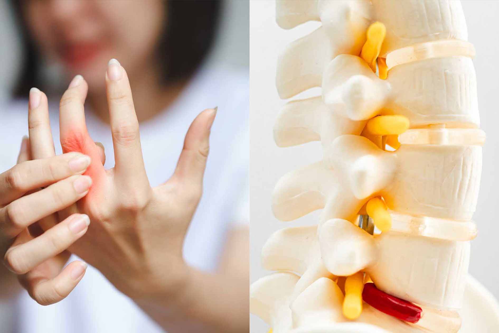 La artritis por auto exento es una enfermedad inflamatoria cronica, en la que el sistema inmune confunde y ataca las articulaciones sanas del cuerpo, causando hinchazon, dolor, rigidez. Grafico: Dinh Dinh