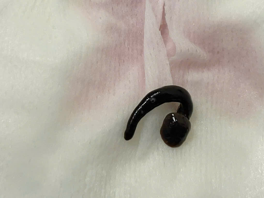The foreign object is a live stream slough about 5cm long in the tracheum of a 3-year-old child that has been removed. Photo: BVCC