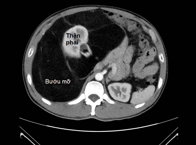 Escaneo de tomografia computarizada con cavidad abdominal del paciente, compresion tumoral de organos internos. Foto: BVCC