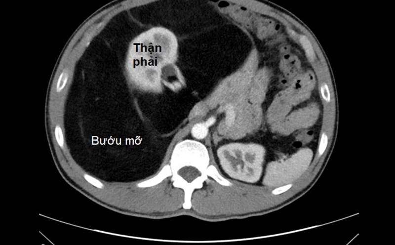CT scan of the patient's abdomen, the tumor compressing the internal organs. Photo: BVCC