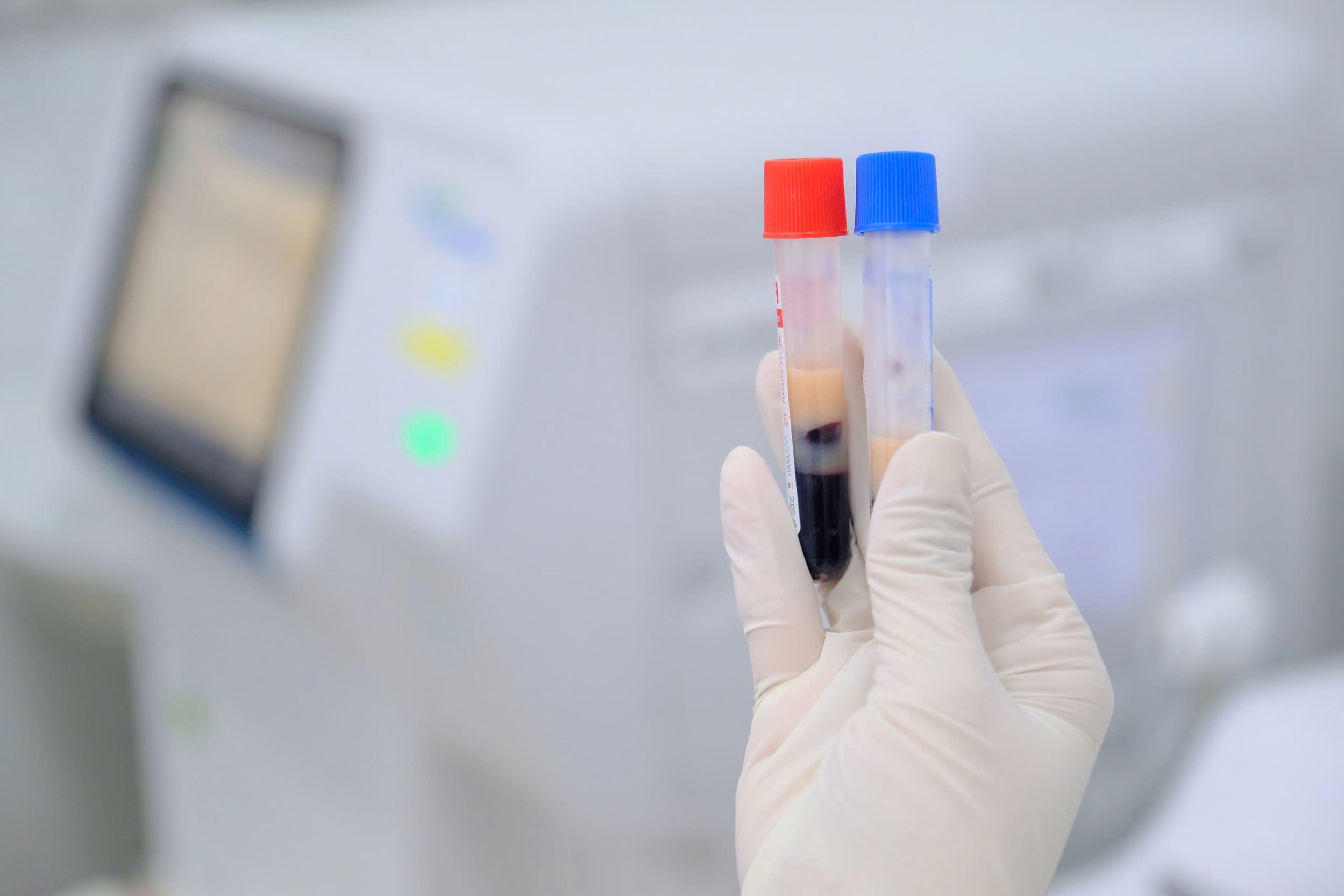 Leche suero opaco. Foto: El hospital proporciona