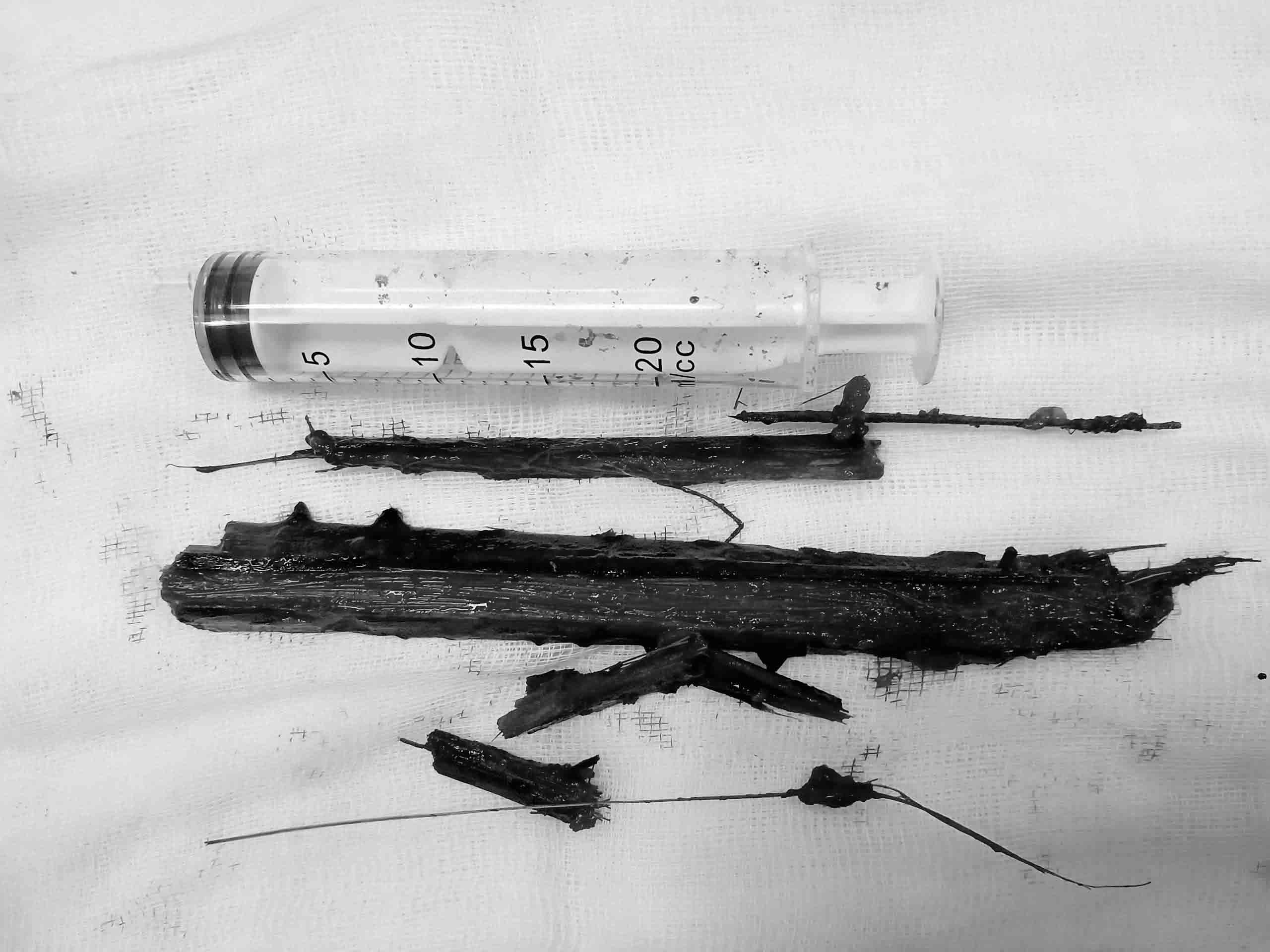 El objeto extraño es una rama de palmera en el cofre de la Sra. H durante mas de 2 años, que ha sido eliminada por el Doctor del Hospital General de Ha Tinh. Foto: Quang Tuan.