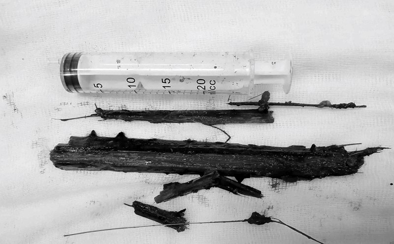 The foreign object is a palm tree branch that has been in Ms. H's chest for more than 2 years and has just been removed by a doctor at Ha Tinh General Hospital. Photo: Quang Tuan.