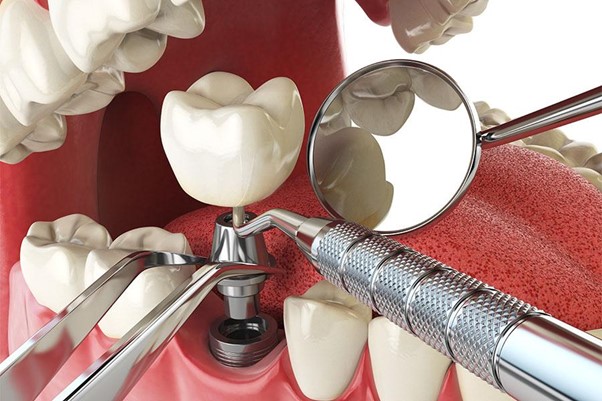 Gia cay ghep Implant khong qua cao nhu nhieu nguoi van nghi. Anh: Nha khoa I-Dent