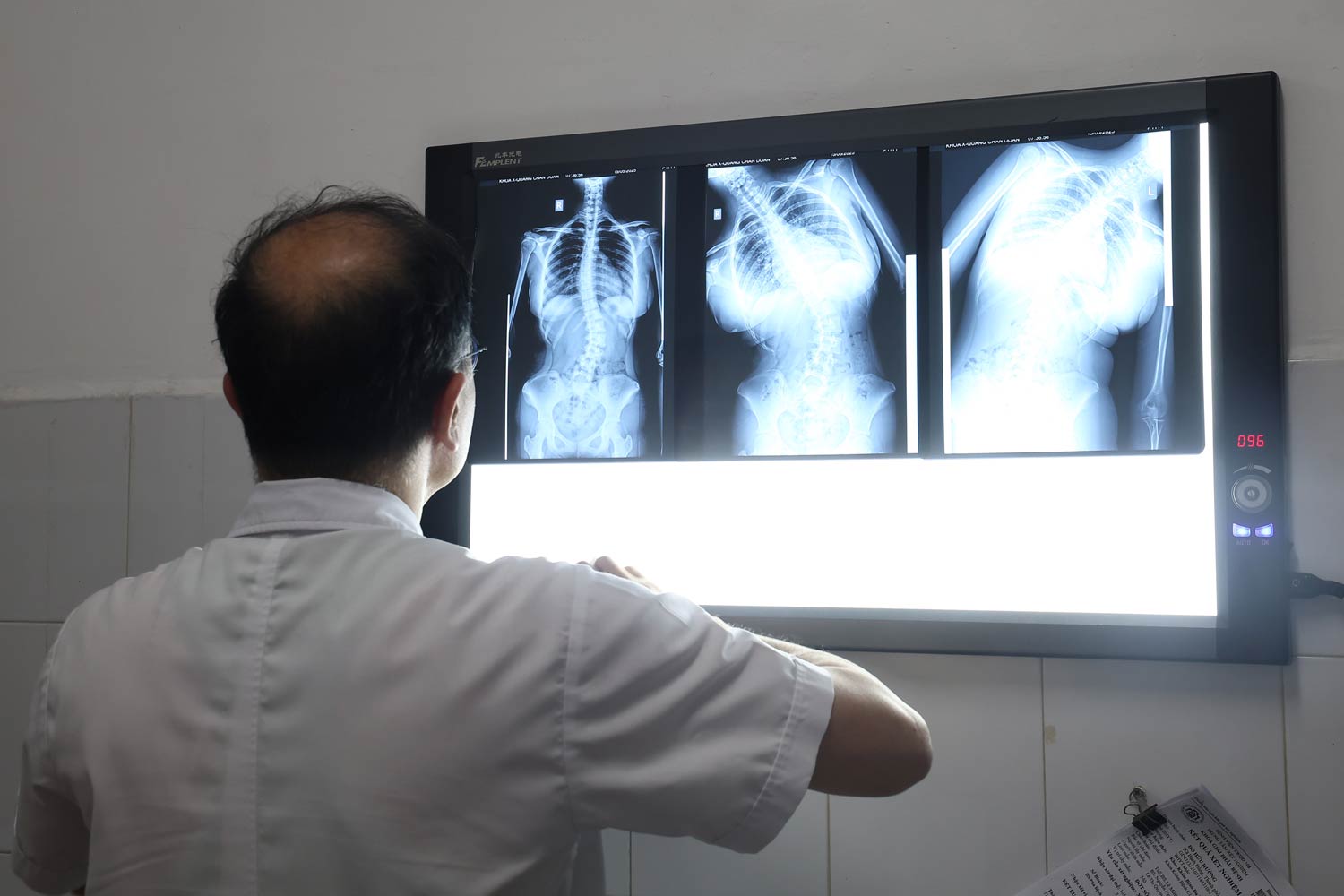 La escoliosis en los niños puede causar efectos inesperados en la salud