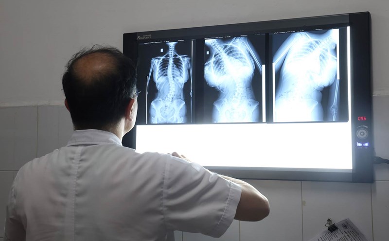 Spinal curvature in children can cause many unexpected effects on health