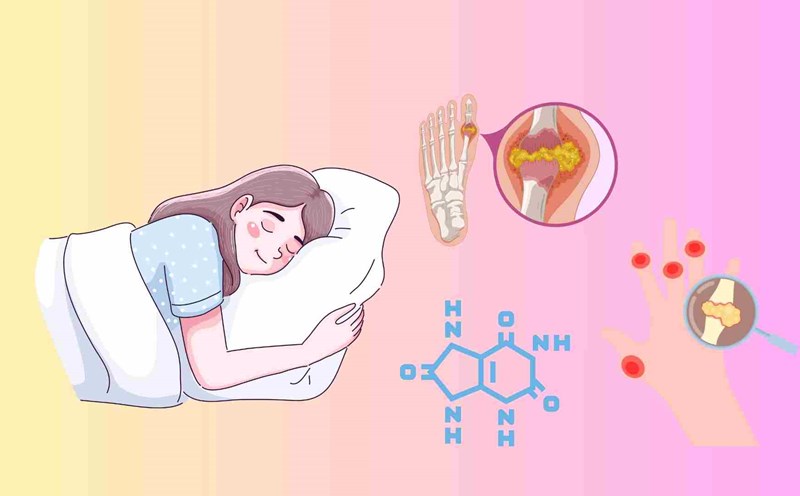 Sleeping in the wrong position can make gout pain worse, especially at night. So how should people with high uric acid levels sleep to sleep well and have less pain? Graphics: Huyen Trang