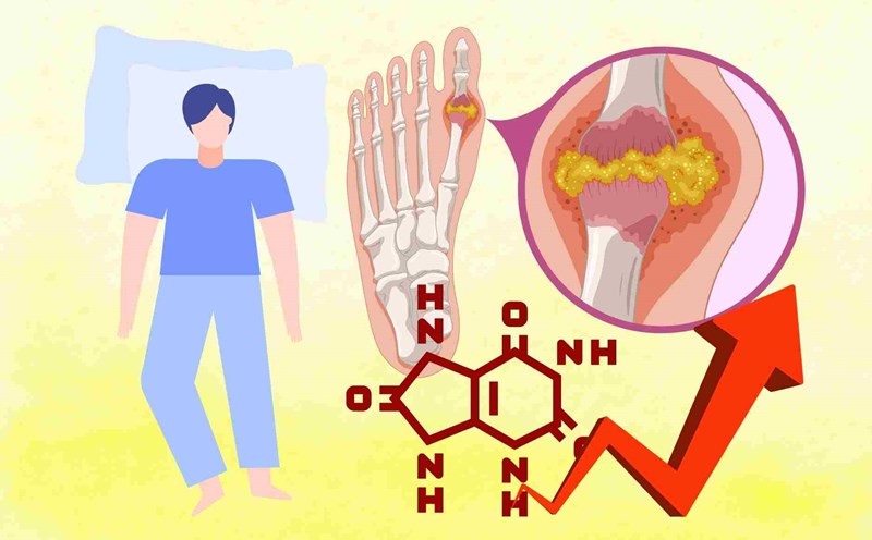 Golden hour to go to bed for people with high uric acid. Graphics: Dinh Dinh